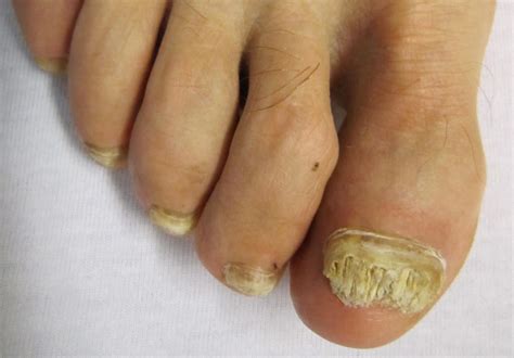 Fungal Nails Thick Yellow Ugly Toenails