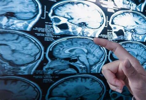 Faktanya, tidak ada jenis sakit kepala spesifik yang dapat memprediksi apakah seseorang memiliki tumor otak atau bukan. Kanser otak sekunder (Secondary brain cancer) - Simptom ...