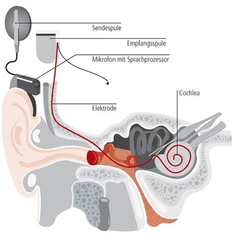 Cochlea Implantat — Gesundheitslexikon