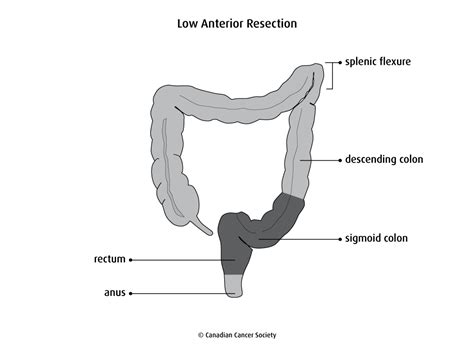 Lars score is a tool consisting of five items, which are as follows: Bowel resection - Canadian Cancer Society