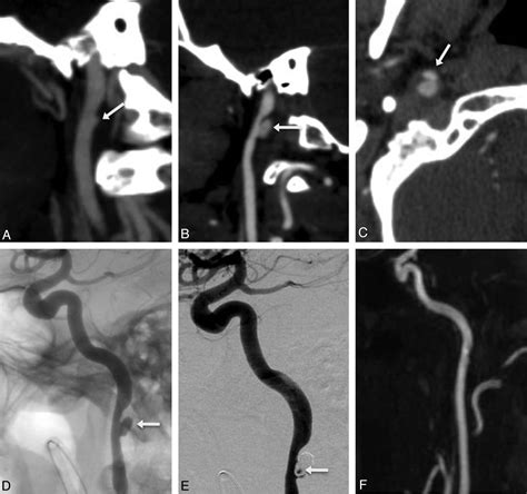 Endovascular Repair Of Traumatic Cervical Internal Carotid Artery