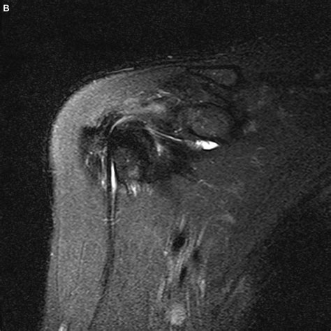 Arthroscopic Image Of A Partial Long Head Of Biceps Tendon Tear A