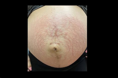 Pruritic Papules During Pregnancy Clinical Advisor