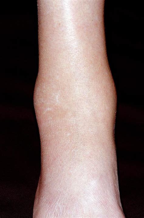 Gout In The Ankle Photograph By Dr P Marazzi Science Photo Library
