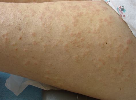 Herpes Gestationis Pemphigoid Gestationis العقبول الحملي