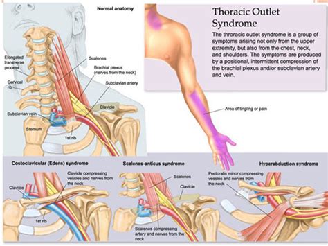 Cervical Ribthoracic Outlet Syndromeoverviewdiagnosis And Treatment
