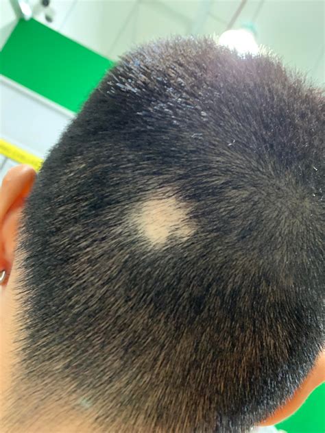 Bald Spot On Back Of Head Wholesale Prices Save 66 Jlcatjgobmx