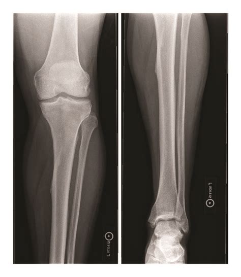 Initial X Ray Of The Left Tibia And Fibula Is Displayed There Is Mild