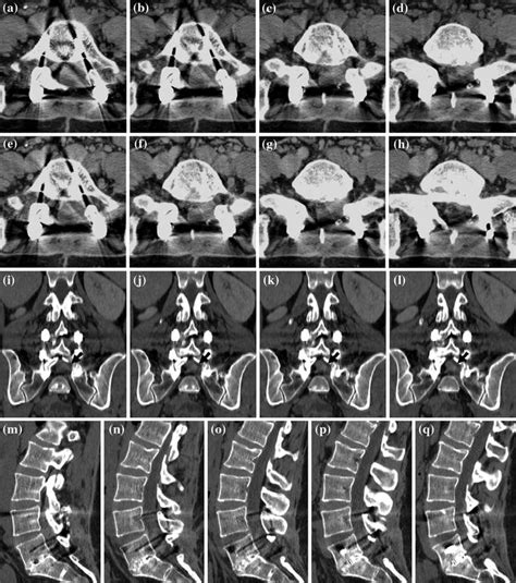 Herniated Lumbar Disk Diskectomy And Stabilization Radiology Key