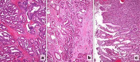 Tumor Grading A Well Differentiated Adenocarcinoma B Moderately Download Scientific