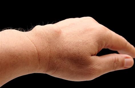 Ganglion Cyst Frequently Asked Questions