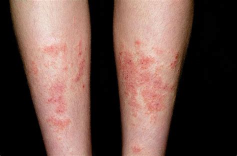 Allergic Skin Reaction To Shin Pads Photograph By Dr P Marazziscience