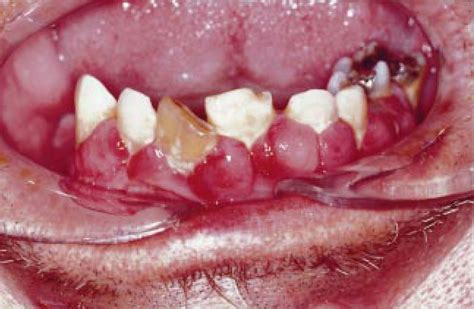 Gross Gingival Hyperplasia In A Hypertensive Patient On Treatment With