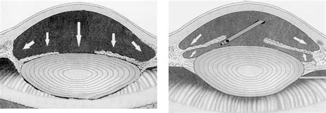 Management Of Lens Iris Diaphragm Retropulsion Syndrome During