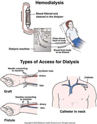 Hemodialysis Access Surgical Specialists Of Southwest Florida