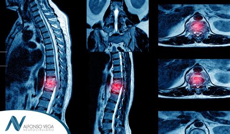 ¿qué Es Una Lesión De Médula Espinal Dr Alfonso Vega