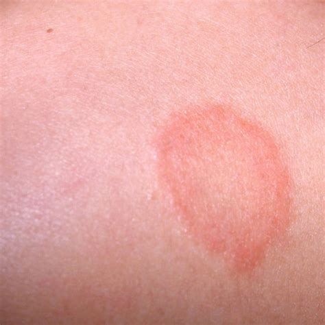 Common Fungal Skin Infections