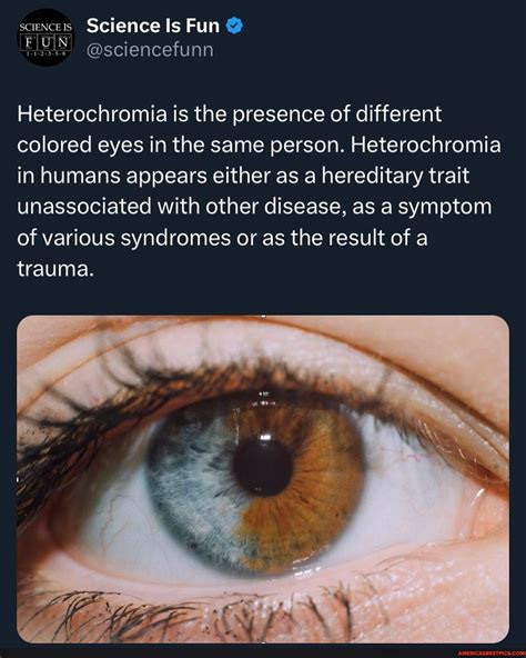 Congenital Heterochromia Is Usually Harmless And Rarely Reflects An