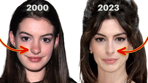 Anne Hathaway Before And After Nose Job
