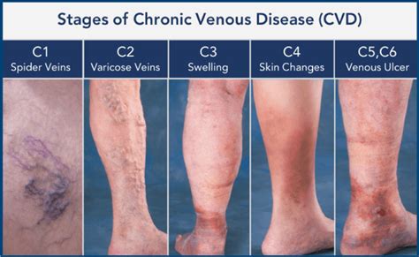 Chronic Venous Insufficiency Treatment Specialist Vascular Health Center