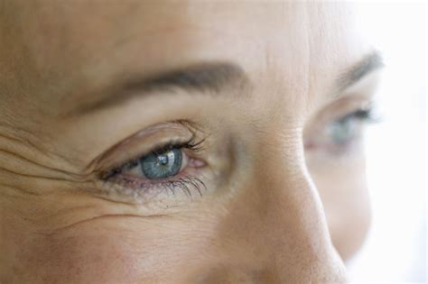 5 Ways Lupus Affects The Eyes