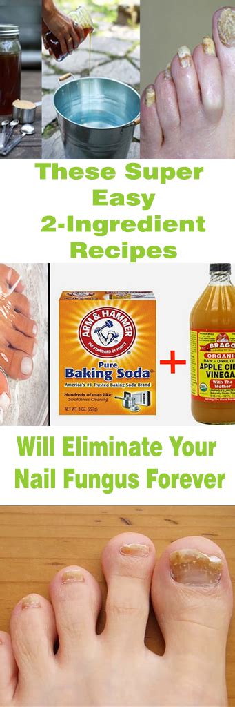 This Super Easy 2 Ingredient Recipe Will Eliminate Your Nail Fungus