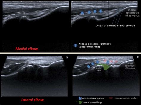 Presentation1pptx Ultrasound Examination Of The Elbow Joint