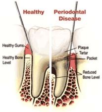 Periodontal Disease Tooth Comfort Dental Of Lafayette