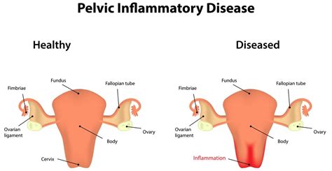 Pelvic Inflammatory Disease Pid Symtpoms Treatment