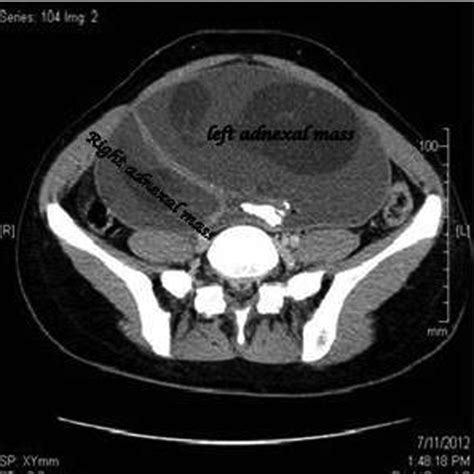 Bilateral Dermoid Ovarian Cyst In An Adolescent Girl Bmj Case Reports