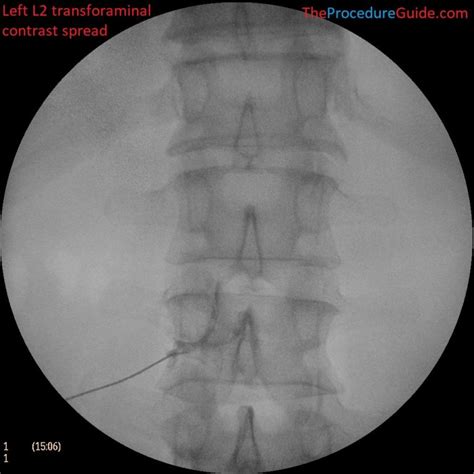 Fluoroscopic Guided Thoraciclumbar Transforaminal Epidural Steroid