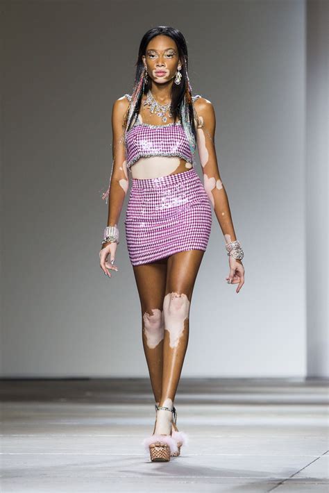 Canadian Model With Vitiligo Who Inspires Fashion World Chantelle