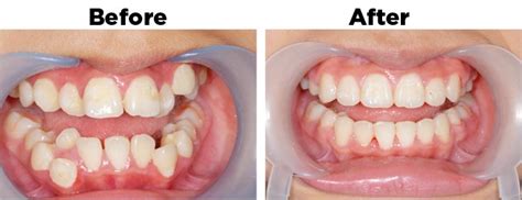 Maybe you would like to learn more about one of these? When you know that you need braces | Orthodontic Excellence