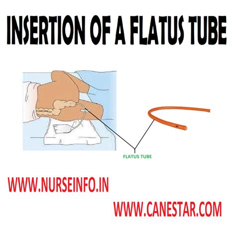 Insertion Of A Flatus Or Rectal Tube Purpose Instructions