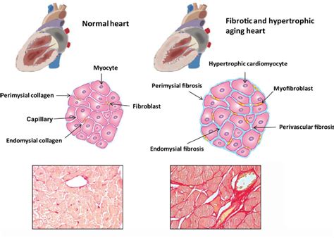 Fibrosis Of The Aging Heart Cardiac Aging Is Associated With