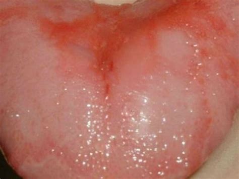 Red Bumps On Back Of Tongue Causes Symptoms And Treatment Healthrid