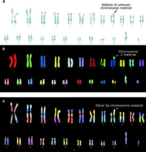 Multicolour Karyotyping The Lancet