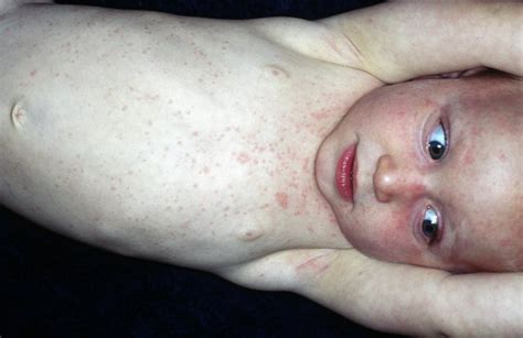 Roseola Rash A Viral Rash On The Skin Of A Child Stock Photo Download