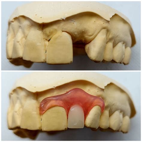 Nesbit Flexible Partial Denture Dental Lab Direct