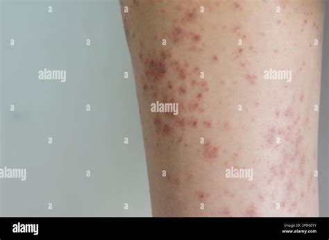 Red Rash Girl Skin Disease Caused By Allergies To Drugs Food
