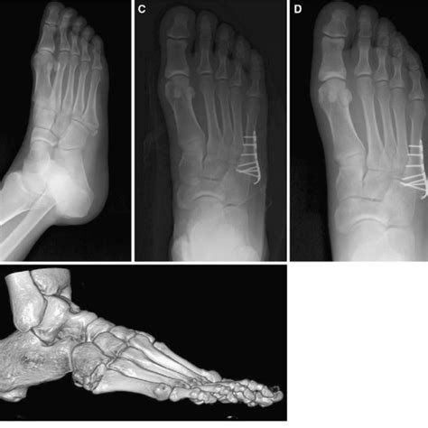 A 48 Year Old Man With A Fifth Metatarsal Base Fracture A Preoperative
