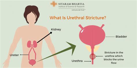 Urethral Stricture Why You May Have Problems Passing Urine