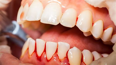 Bleeding Gums Causes Prevention And Treatment Scottsdale Cosmetic