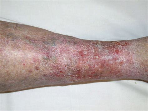 Stasis Dermatitis Symptoms Causes Diagnosis Treatment