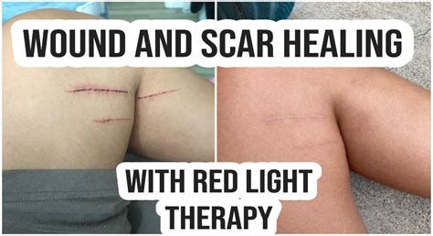 Wound And Scar Healing With Red Light Therapy Red Light Therapy Bed Body Balance System