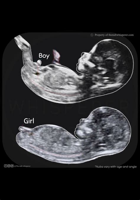 Baby Gender Using Nub Theory Baby Gender Prediction Baby Ultrasound
