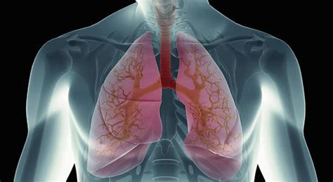 The effect of ursodeoxycholic acid therapy on liver fibrosis progression in primary biliary. Symptoms And Treatment Of Cystic Fibrosis (CF Disease ...