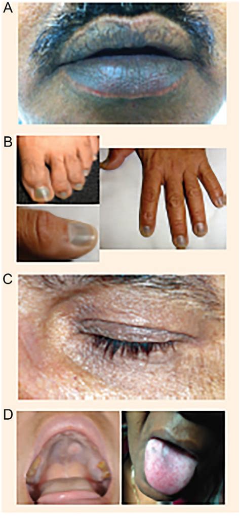 Examples Of Discoloration Taken During The Long Term Extension Studies