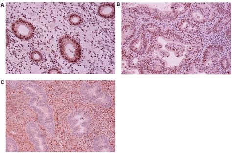 Immunohistochemical P53 Expression And Absence Of P53 Expression In