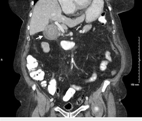 Initial Ct Scan Illustrating The Gallstone Within The Gallbladder